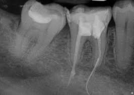 Does Anyone Know If The Gutta Percha Made It To The End Of This Rootcanal Dental Fun Dental Jokes Dental Assistant Humor