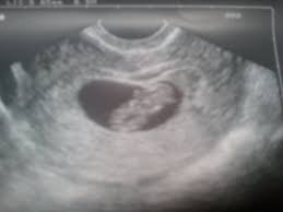 La hauteur utérine est de 32 cm. Bebe A Presque 2 Mois De Grossesse 8sg 10sa Blog De 16 Ans Enceiiinte
