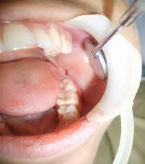 Image result for Alveolitis sicca)