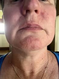 Anyone experience hair lose while