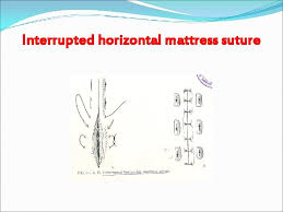 The horizontal mattress suture is useful in areas where there is little subcutaneous dermal tissue, making wound edge eversion difficult. Closure Material Wound Wound Damaged Skin Or Soft