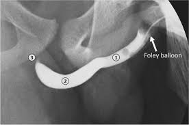 Image result for Retrograde Urethrogram