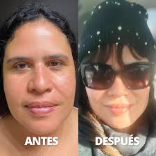 Mira este increíble antes y después de un Facelift con tecnología avanzada.  ✨ Rejuvenecemos de manera natural, redefiniendo contornos y eliminando  flacidez. 💉 ¿Te gustaría un cambio así? Agenda tu consulta.
