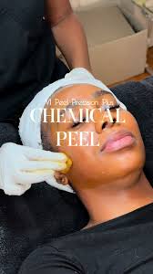 Chemical Peel in Las Vegas Black Skin