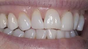 Check spelling or type a new query. Black Triangles Between Teeth Missing Gum Between Teeth