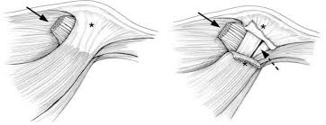 Symptoms of an acute ligament sprain will be sudden onset pain on the inside of the elbow. Thumb Collateral Ligament Injury Hand Orthobullets