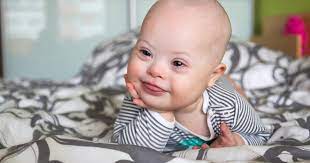 Down Syndrome Related Medical Conditions