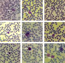 Low platelet info, remedies that will help your low platelets. The Role Of Curcumin On Reduced Leukocyte And Platelet Counts In Rats After Exposure To Ultraviolet Light From Compact Fluorescent Lamps A Morphological Study Shiraz E Medical Journal Full Text