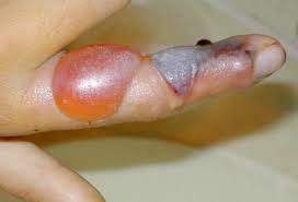 Image result for snake bite drug