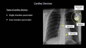 How To Interpret A Chest X Ray Lesson 9 Atelectasis Lines Tubes Devices And Surgeries Youtube