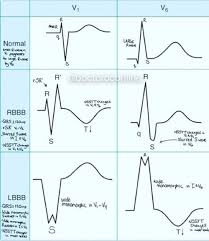 Rbbb Vs Lbbb Brace Your Ecg Knowledge Share With Friends Ecg Ekg Lbbb Rbbb Cardiology He Icu Nursing Emergency Medicine Emergency Nursing