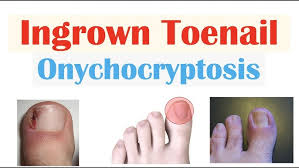 Image result for Onychogryphosis feet