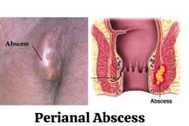 Image result for Perianal Abscess