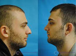 Rhinoplasty Rhinoplasty Nose Surgery Nose