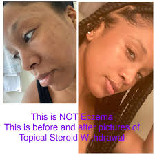 Lea Vasquez shares her Topical Steroid Withdrawal experience : u/Lea_Vasquez