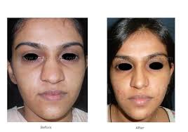 We have everything you are looking for! Rhinoplasty Nose Job Gallery Dr Jain Before And After