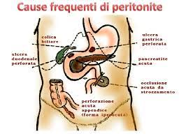 Le plus souvent d'origine infectieuse, la péritonite constitue une urgence médicale. Classificazione Delle Peritoniti Acute