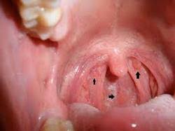 Sore throat and hoarseness that persists for more than two weeks. Cancer Of Throat In Dehradun Id 6889220448