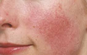 Image result for red rash face