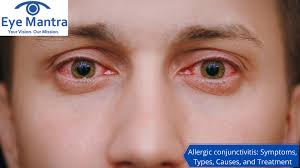 Image result for Allergic Conjunctivitis