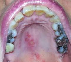 Image result for Oral herpes roof of mouth
