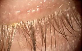 Image result for Demodex folliculorum