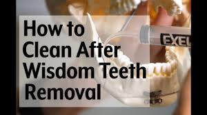 This can also make it harder to clean your teeth properly, which can lead to periodontitis ( gum after the procedure, your dentist or surgeon will likely stitch up the surgical sites then put gauze over the holes. Post Op Video Instruction How To Clean With A Syringe After Wisdom Teeth Removal Youtube