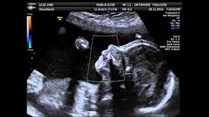 Une fuite du liquide amniotique. Echographie D Un Foetus Qui Crache Du Liquide Amniotique Youtube