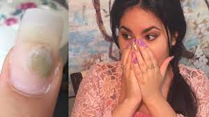 I Got Fungus From Acrylic Nails Youtube