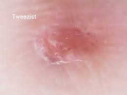 Facial bumps with ingrown hairs are usually painful and can irritate your skin too particularly when you touch or try to pop them now and then. Ingrown Hair Under Scab And Skin Extraction Youtube