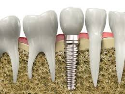 It also helps keep your bones and teeth strong. Jawbone Regeneration For Dental Implants