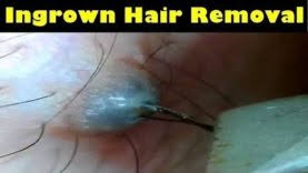 Many people who have thick or curly hair get a type of ingrown hair called pseudofolliculitis. Biggest Ingrown Hair Removal Infected Ingrown Hair Pimple Pimple Popping Videos