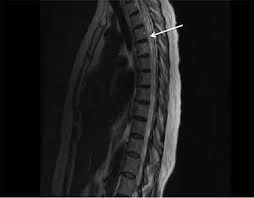 Involves the infection or the inflammation of the. Transverse Myelitis Symptoms Diagnosis And Treatment Bmj Best Practice Us