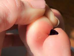 Home Remedy For A Plantar Wart Because Evidently I M Gross The Art Of Doing Stuff
