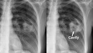 Image result for Lung Abscess