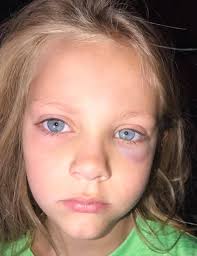 Hey gals! I just got home from Texas and while I was there my little 5 year  old niece broke her bone in 2 places when a teenager jumped