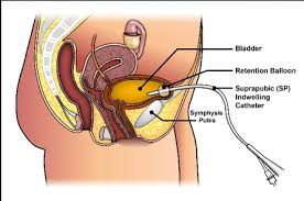 Wear cotton boxers or underwear: Indwelling Catheter Definition Types