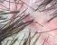 Multiple Hairs In One Follicle Pubic
