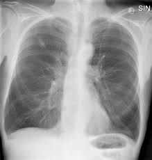 Lung pathology of fatal severe acute respiratory syndrome. Tuberculosis Mimicking Lung Cancer Sciencedirect