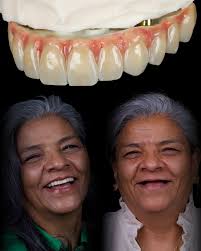 Toronto CrCo+ Zirconia + Nexco Gingiva #dentaltechnology #dentaltechnician  #exocad #theet #allonsix #implantedental #dentiphoto #dentaltech