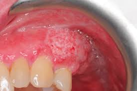 Image result for gums cancer symptoms