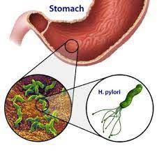 En finir avec le mal d'estomac, l'acidité gastrique, brûlures, helicobacter, rgo, ulcère, gastrite, remontées acides etc.méthode naturelle: Helicobacter Pylori Et Ulcere De L Estomac Alternatives Naturelles La Nutrition Sante