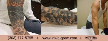 At rocky mountain laser center, colorado springs, co we offer a safe and effective laser therapy for permanent tattoo removal. Ink B Gone Tattoo Removal Home Facebook