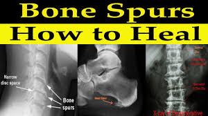 Factors that contribute to bone spurs include aging, heredity, injuries, poor nutrition and poor posture. How To Heal Bone Spurs Naturally Dr Alan Mandell Dc Youtube