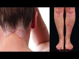 Uvb Light Treatment For Psoriasis Before And After My Story Youtube