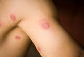 Is Ringworm Contagious How Does It Spread