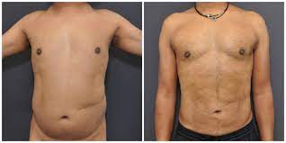In addition, surgeons who practice in densely populated urban areas tend to charge higher fees for. What Is Liposuction My Beauty Trip Thailand
