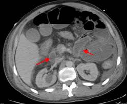 Image result for Neutropenic Colitis