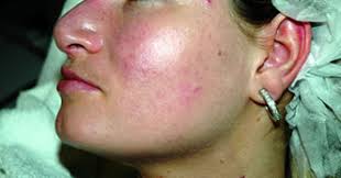 Gel soothes, calms and removes dead aftershave skin with willow herb, lavender, glycolic, and salicylic acids. Ingrown Hair Archives Pak Ladies