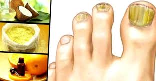 Hongos en las uñas hola chicas, buenas tardes. Remedio Casero Efectivo Quitar Los Hongos De Los Pies Ahora Es Posible Top 3 Remedios Caseros